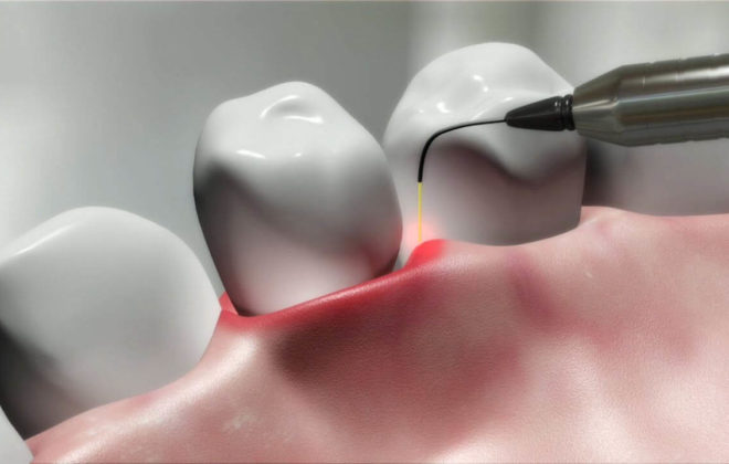 verident-terapie-laser-dentale-2