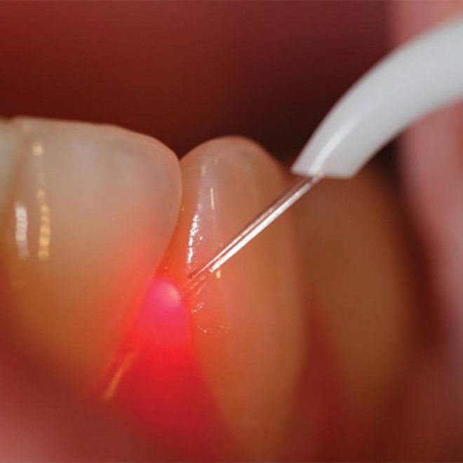 verident-terapie-laser-dentale-4